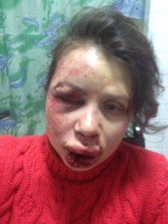 Журналістку та активістку Євромайдану Тетяну Чорновіл жорстоко побили Журналістку та активістку Євромайдану Тетяну Чорновіл жорстоко побили