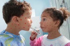 На Глибоччині вже двоє дітей захворіли на кір На Глибоччині вже двоє дітей захворіли на кір